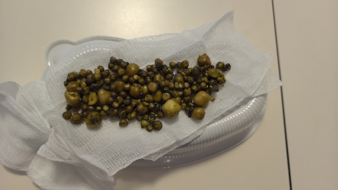 Bursa'da 77 yaşındaki kadının safra kesesinden 213 tane taş çıkarıldı