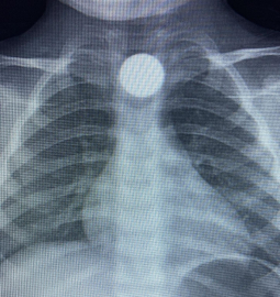 3 yaşındaki Bilal'in, yuttuğu 50 kuruş yemek borusunda takıldı